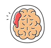 Tai biến mạch m&aacute;u n&atilde;o &ndash; di chứng sau đột quỵ